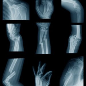 Dr HS PRETORIUS BSc MB ChB MMed (Orth)(Stell) Specialist Orthopaedic Upper Limb & Reconstructive Surgeon