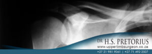 Dr Pretorius Upper Limb Surgeon - shoulder_xray